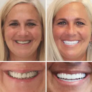 Natravor™ - Dentadura Premium
