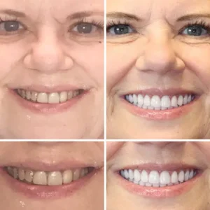 Natravor™ - Dentadura Premium