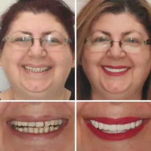 Natravor™ - Dentadura Premium