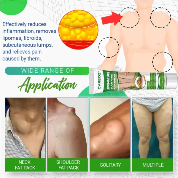 ⏰Last Day Promotion: 60% OFF🔥 Cvreoz® LipomaCure Soothing Ointment
