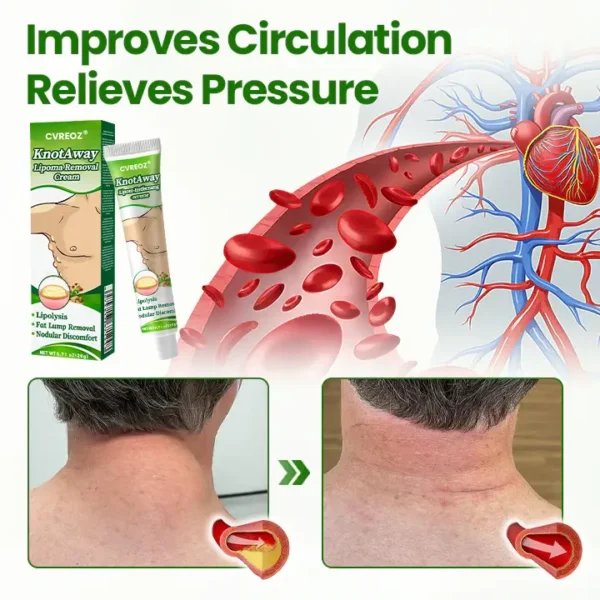 LIMITED TIME SALE OFF 70%🔥 Cvreoz® KnotAway Lipoma Removal Cream