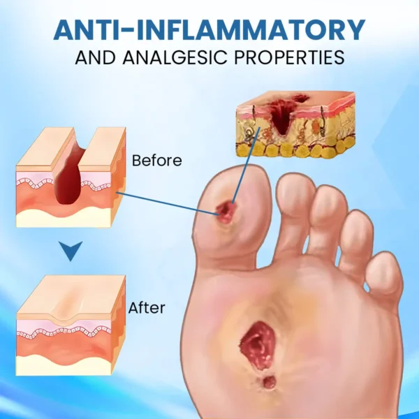 ⏰Last Day Promotion: 70% OFF 🔥Cvreoz® Diabetic Foot Healing Cream