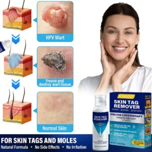 🔥Last Deal: 60% Off🔥 CVREOZ® TagRecede Cryo Treatment Spray