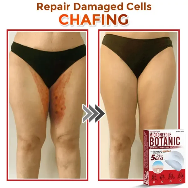 Natravor® MicroNeedle Botanic Skin Tag Removal Patch ✅Australian Made