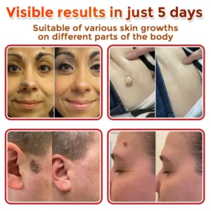 Natravor® MicroNeedle Botanic Skin Tag Removal Patch ✅Australian Made