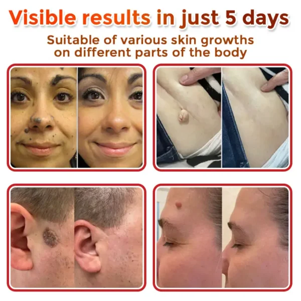 Natravor® MicroNeedle Botanic Skin Tag Removal Patch ✅Australian Made