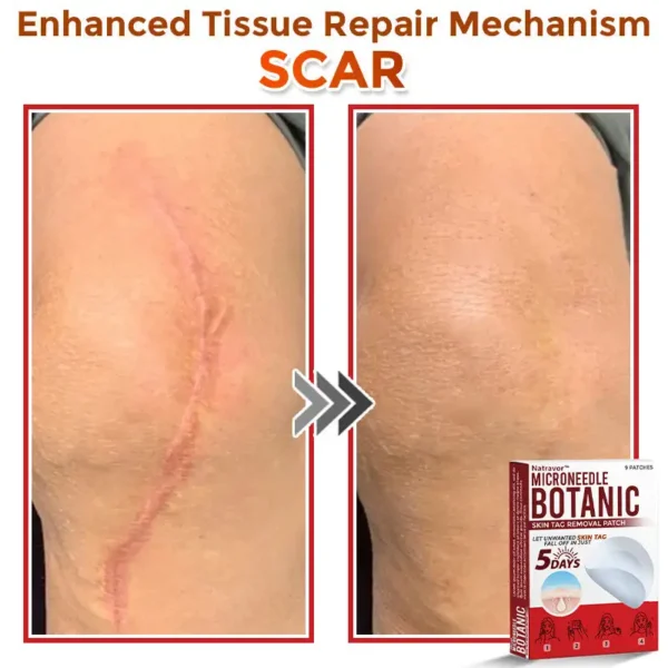 Natravor® MicroNeedle Botanic Skin Tag Removal Patch ✅Australian Made