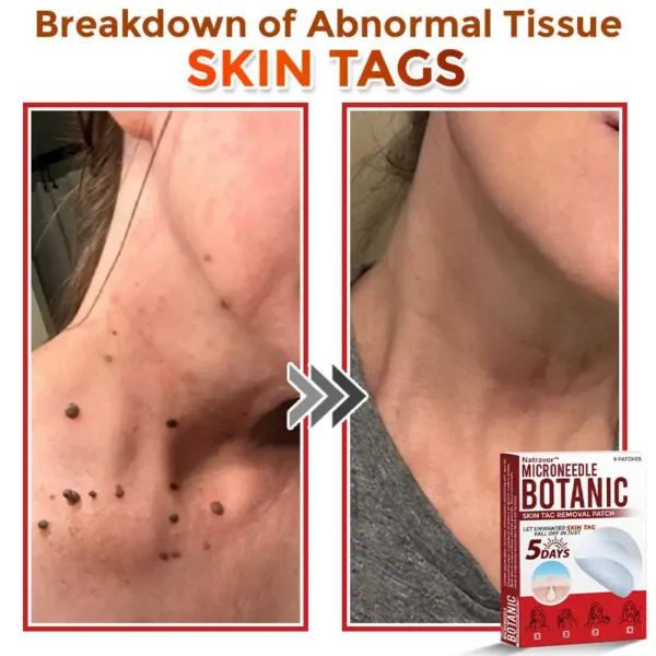 Natravor® MicroNeedle Botanic Skin Tag Removal Patch ✅Australian Made