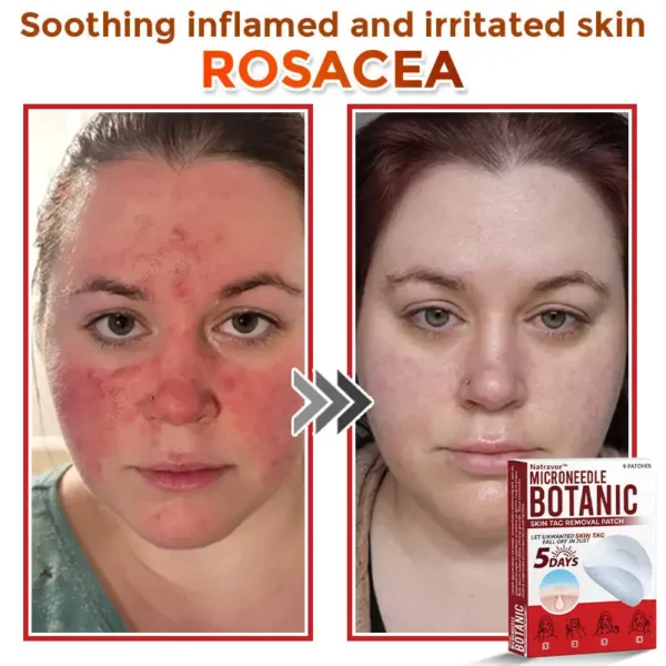 Natravor® MicroNeedle Botanic Skin Tag Removal Patch ✅Australian Made
