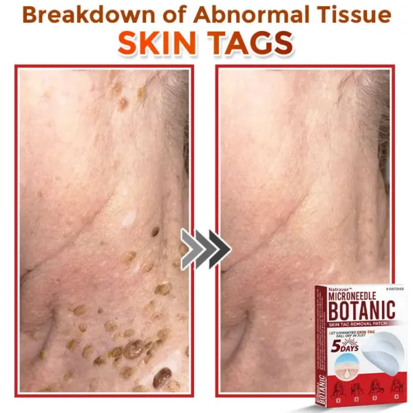 Natravor® MicroNeedle Botanic Skin Tag Removal Patch ✅Australian Made