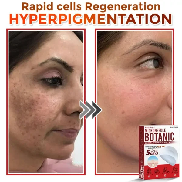 Natravor® MicroNeedle Botanic Skin Tag Removal Patch ✅Australian Made