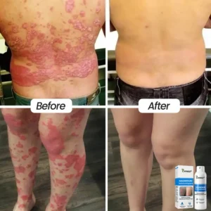 Cvreoz® Magnesium Herbal Psoriasis Spray ⚕️ FDA Certified