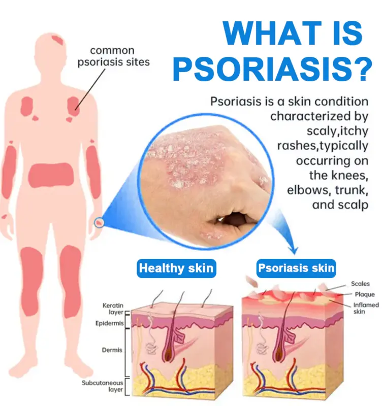 Cvreoz® Magnesium Herbal Psoriasis Spray ⚕️ FDA Certified