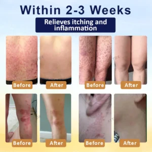 🎉HOT SALE: 60% OFF🔥 8M+ SOLD️🏆Cvreoz® PsoriasisCare Mellifera Venom Skin Healing Spray