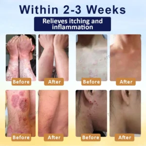 🎉HOT SALE: 60% OFF🔥 8M+ SOLD️🏆Cvreoz® PsoriasisCare Mellifera Venom Skin Healing Spray