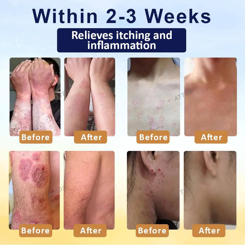 🎉HOT SALE: 60% OFF🔥 8M+ SOLD️🏆Cvreoz® PsoriasisCare Mellifera Venom Skin Healing Spray