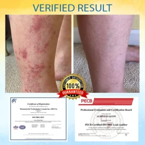 🎉HOT SALE: 60% OFF🔥 8M+ SOLD️🏆Cvreoz® PsoriasisCare Mellifera Venom Skin Healing Spray