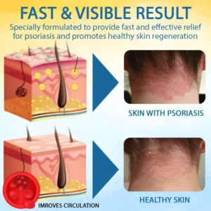 🎉HOT SALE: 60% OFF🔥 8M+ SOLD️🏆Cvreoz® PsoriasisCare Mellifera Venom Skin Healing Spray