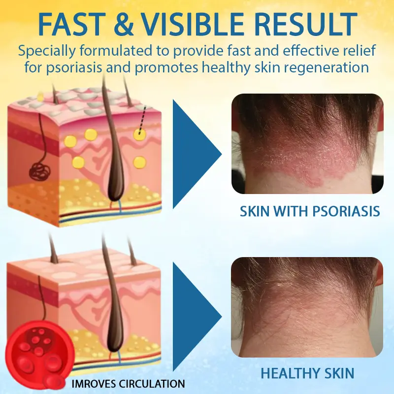 🎉HOT SALE: 60% OFF🔥 8M+ SOLD️🏆Cvreoz® PsoriasisCare Mellifera Venom Skin Healing Spray