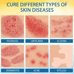 🎉HOT SALE: 60% OFF🔥 8M+ SOLD️🏆Cvreoz® PsoriasisCare Mellifera Venom Skin Healing Spray