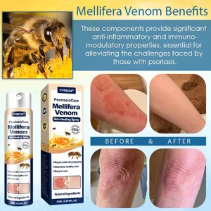 🎉HOT SALE: 60% OFF🔥 8M+ SOLD️🏆Cvreoz® PsoriasisCare Mellifera Venom Skin Healing Spray