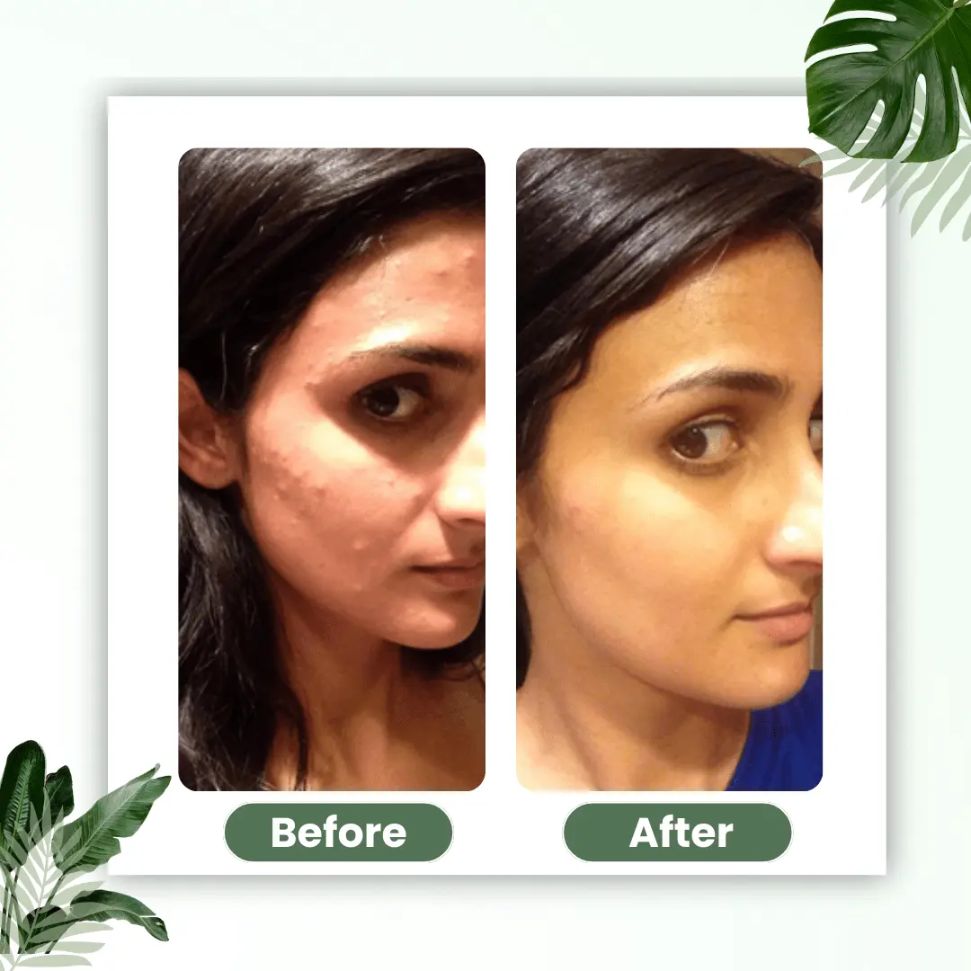 🔥Hot Sale 50% OFF🔥Natravor® Green Tea Deep Cleanse Mask Stick ACE 1