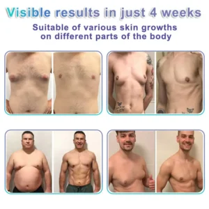 NATRAVOR® NanoMedix Gynecomastia Chest Fatburn & Firm Patch