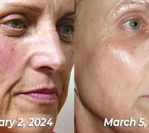 flysmus™ BioRegen PDRN Salmon DNA Ampoule