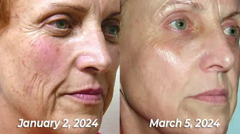 flysmus™ BioRegen PDRN Salmon DNA Ampoule