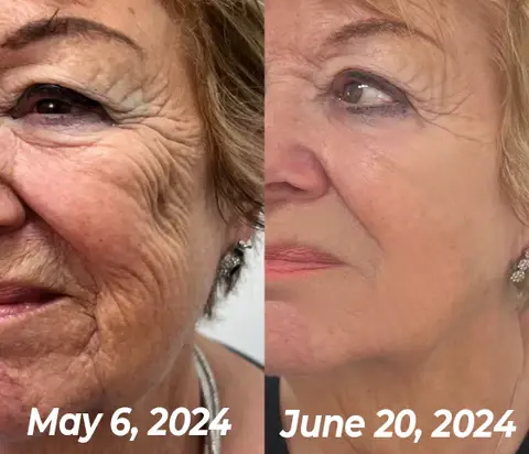 flysmus™ BioRegen PDRN Salmon DNA Ampoule