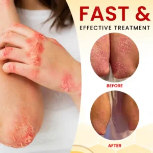 🏷️ EXCLUSIVE DEAL! 50% OFF - Cvreoz® Bee Venom Psoriasis Treatment Cream