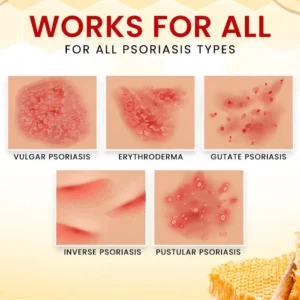 🏷️ EXCLUSIVE DEAL! 50% OFF - Cvreoz® Bee Venom Psoriasis Treatment Cream