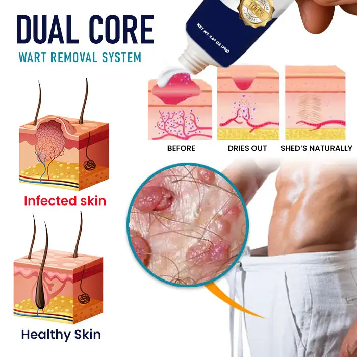 Cvreoz® Genital Warts Remover Cream 👨Designed for Men