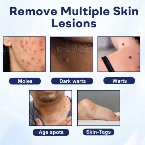 Cvreoz® Mole and Wart Removal Cream