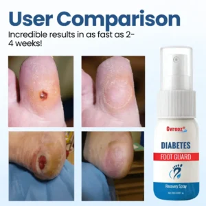 Cvreoz®  𝐃𝐢𝐚𝐛𝐞𝐭𝐞𝐬 𝐅𝐨𝐨𝐭 𝐆𝐮𝐚𝐫𝐝 𝐑𝐞𝐜𝐨𝐯𝐞𝐫𝐲 𝐒𝐩𝐫𝐚𝐲