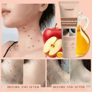 Cvreoz® Purifying Exfoliating Gel for Acanthosis Nigricans, Exfoliation, Dark Spots, Skin Tags, and Eczema