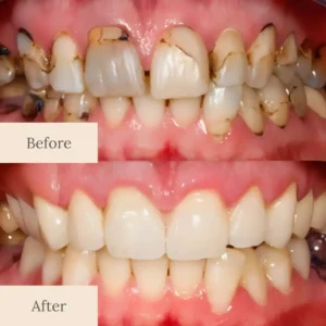 NATRAVOR® Teeth Armor Drops