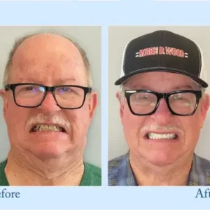 NESLEMY™ Custom-Fit Functional Dentures – Perfectly Fitted in Minutes at Home