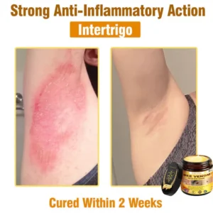 Natravor™ 𝐁𝐞𝐞 𝐕𝐞𝐧𝐨𝐦 𝐀𝐥𝐥-𝐢𝐧-𝐎𝐧𝐞 𝐂𝐫𝐞𝐚𝐦–🌸 Anti-aging,Hydrating, Skin Repair, Even Tone, Acne and Dark Spot Treatment, Wart and Mole Removal, Psoriasis Relief