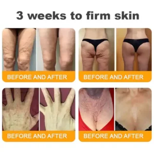 Natravor™ 𝐁𝐞𝐞 𝐕𝐞𝐧𝐨𝐦 𝐀𝐥𝐥-𝐢𝐧-𝐎𝐧𝐞 𝐂𝐫𝐞𝐚𝐦–🌸 Anti-aging,Hydrating, Skin Repair, Even Tone, Acne and Dark Spot Treatment, Wart and Mole Removal, Psoriasis Relief