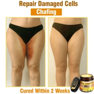 Natravor™ 𝐁𝐞𝐞 𝐕𝐞𝐧𝐨𝐦 𝐀𝐥𝐥-𝐢𝐧-𝐎𝐧𝐞 𝐂𝐫𝐞𝐚𝐦–🌸 Anti-aging,Hydrating, Skin Repair, Even Tone, Acne and Dark Spot Treatment, Wart and Mole Removal, Psoriasis Relief