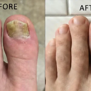 Natravor® NailRescue Bee Venom Spray