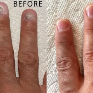 Natravor® NailRescue Bee Venom Spray