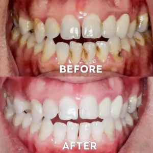 ✅Official Store |🗽Natravor® Fluoride-Free Nano Hydroxyapatite Tooth Powder👨‍⚕️(Treats periodontitis and mouth ulcers, prevents tooth loss, and repairs gum recession)