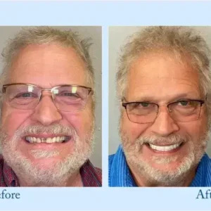 TrueEase™ Dentures