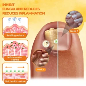 26 Pcs Left !!! - Cvreoz® Bee Venom Nail Renewal Spray - LIMITED-TIME OFFER | Bring out your best self-confidence!💕