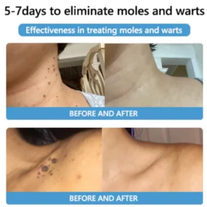 Cvreoz® Bee Venom Mole and Wart Treatment Cream - LIMITED-TIME OFFER | Let out the Best Confidence in YOU!💕