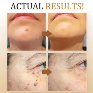 Cvreoz® Bee Venom Mole and Wart Treatment Cream - LIMITED-TIME OFFER | Let out the Best Confidence in YOU!💕