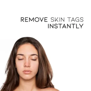 Cvreoz® Bee Venom Mole and Wart Treatment Cream - LIMITED-TIME OFFER | Let out the Best Confidence in YOU!💕