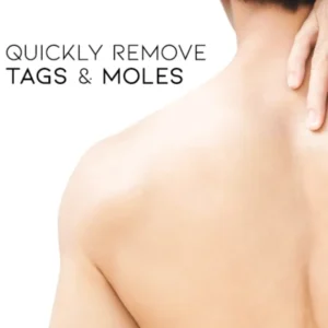 Cvreoz® Bee Venom Mole and Wart Treatment Cream - LIMITED-TIME OFFER | Let out the Best Confidence in YOU!💕